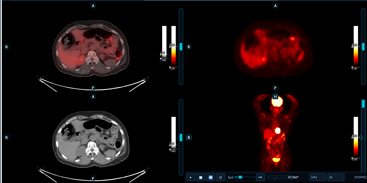 VariaX PET/CT workstation — fused CT and PET axial views with rotating MIP