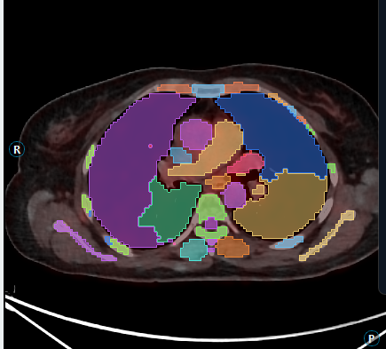 CT with organ segmentation